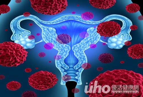 類固醇可抑制卵巢癌轉移  女人養生之道