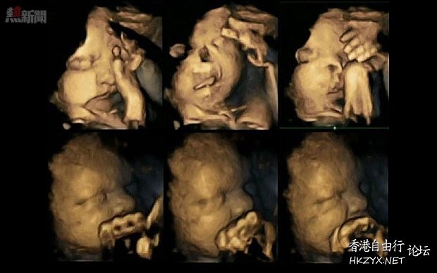 懷孕吸煙-胎兒面容扭曲  媽媽 + 寶寶